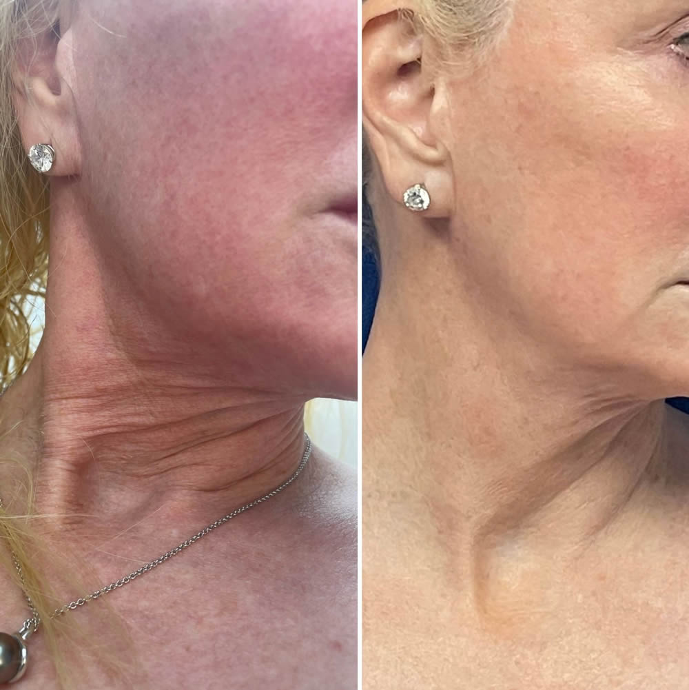 before-and-after-neck
