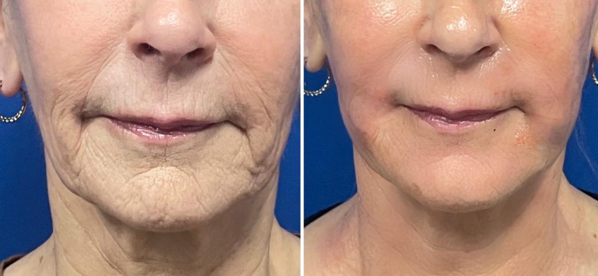 before-and-after