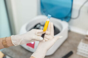 PRP Therapy